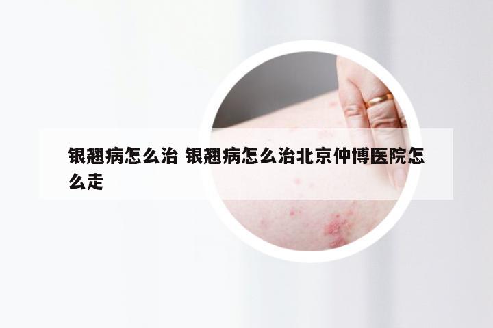 银翘病怎么治 银翘病怎么治北京仲博医院怎么走