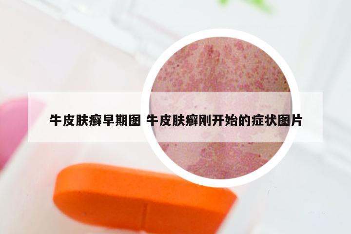 牛皮肤癣早期图 牛皮肤癣刚开始的症状图片