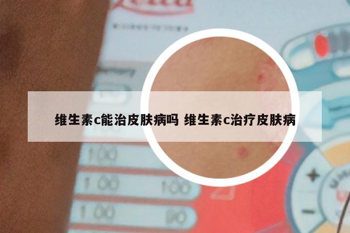 维生素c能治皮肤病吗 维生素c治疗皮肤病