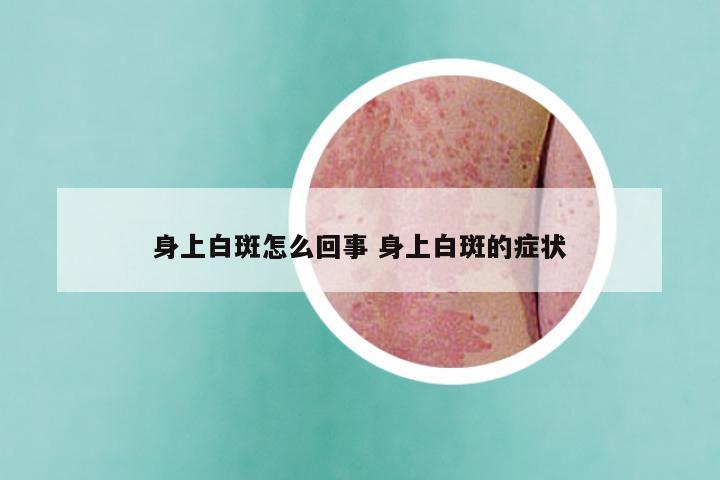 身上白斑怎么回事 身上白斑的症状