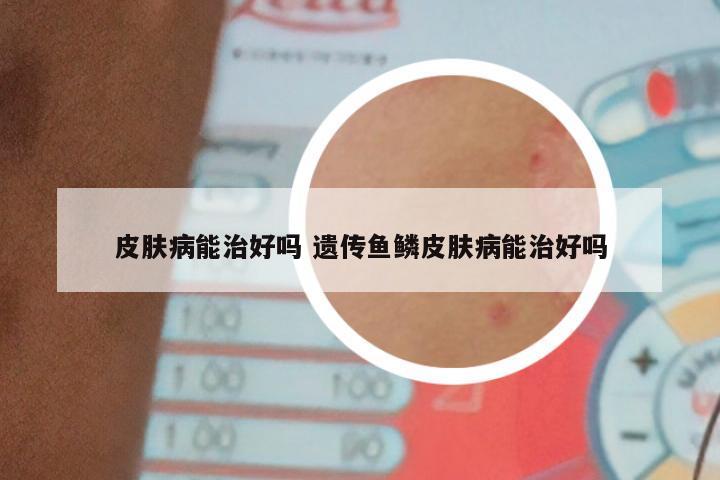 皮肤病能治好吗 遗传鱼鳞皮肤病能治好吗