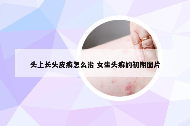 头上长头皮癣怎么治 女生头癣的初期图片