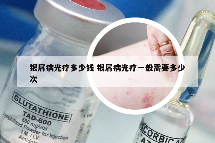 银屑病光疗多少钱 银屑病光疗一般需要多少次