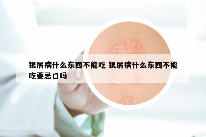银屑病什么东西不能吃 银屑病什么东西不能吃要忌口吗