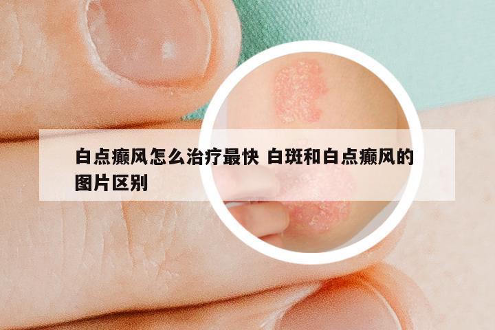 白点癫风怎么治疗最快 白斑和白点癫风的 图片区别