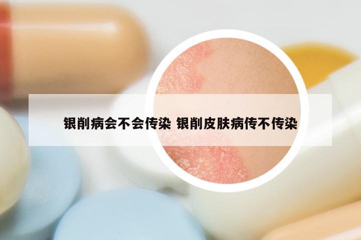 银削病会不会传染 银削皮肤病传不传染
