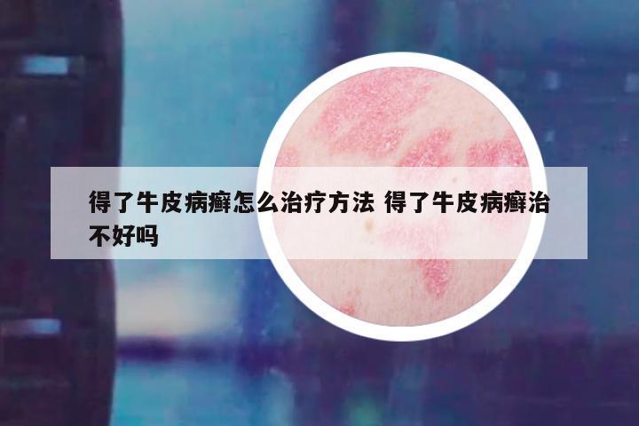 得了牛皮病癣怎么治疗方法 得了牛皮病癣治不好吗