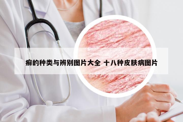 癣的种类与辨别图片大全 十八种皮肤病图片