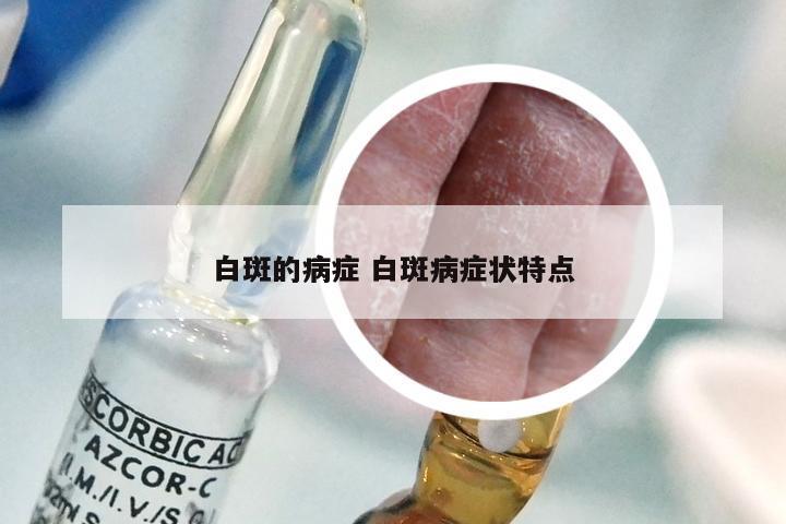 白斑的病症 白斑病症状特点