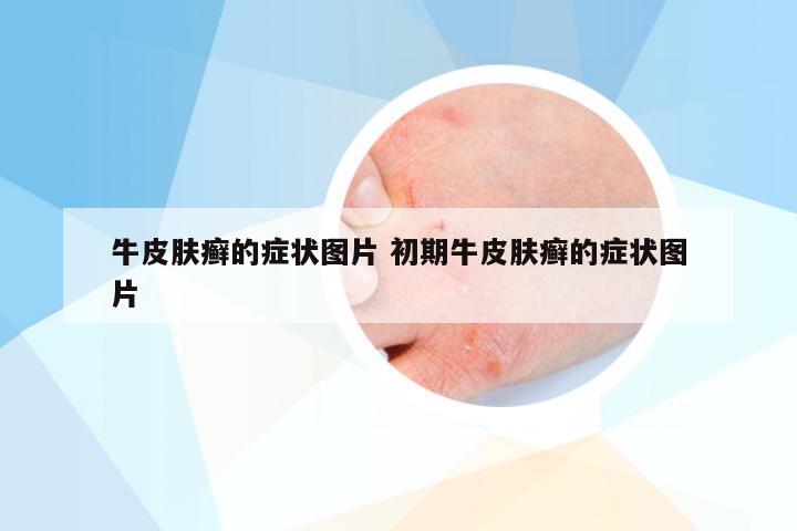牛皮肤癣的症状图片 初期牛皮肤癣的症状图片
