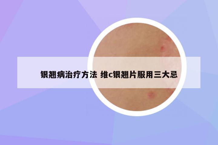 银翘病治疗方法 维c银翘片服用三大忌