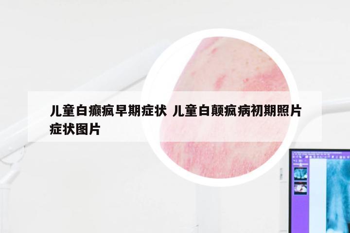 儿童白癫疯早期症状 儿童白颠疯病初期照片症状图片