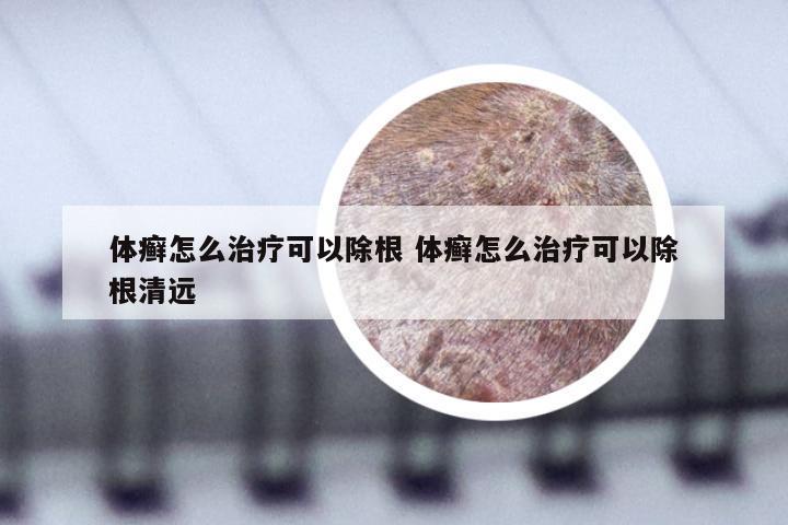 体癣怎么治疗可以除根 体癣怎么治疗可以除根清远