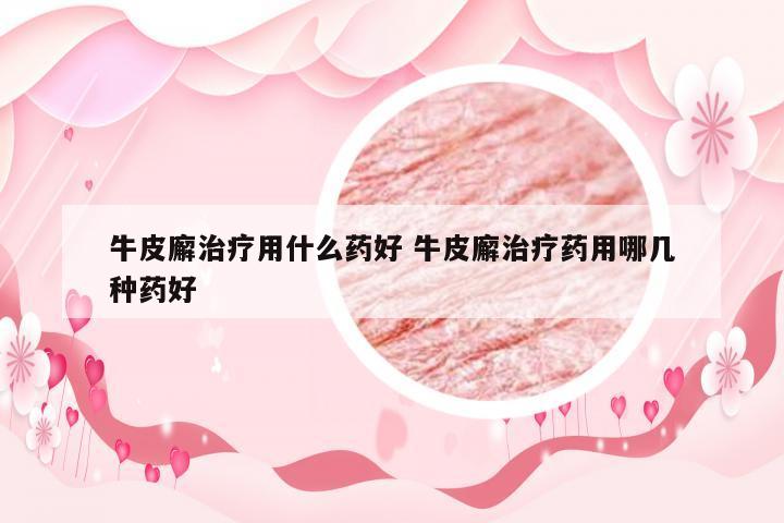 牛皮廨治疗用什么药好 牛皮廨治疗药用哪几种药好