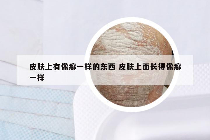 皮肤上有像癣一样的东西 皮肤上面长得像癣一样