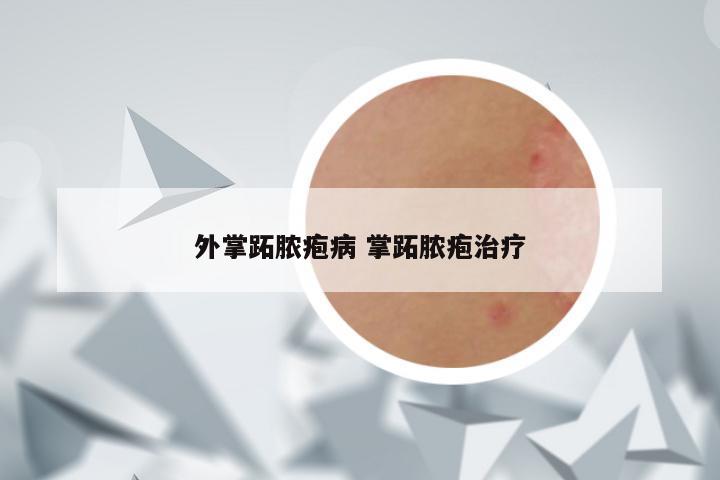 外掌跖脓疱病 掌跖脓疱治疗