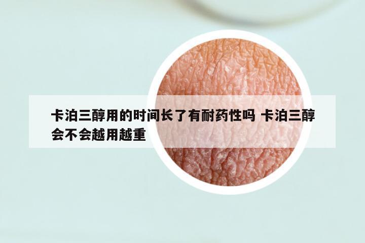 卡泊三醇用的时间长了有耐药性吗 卡泊三醇会不会越用越重