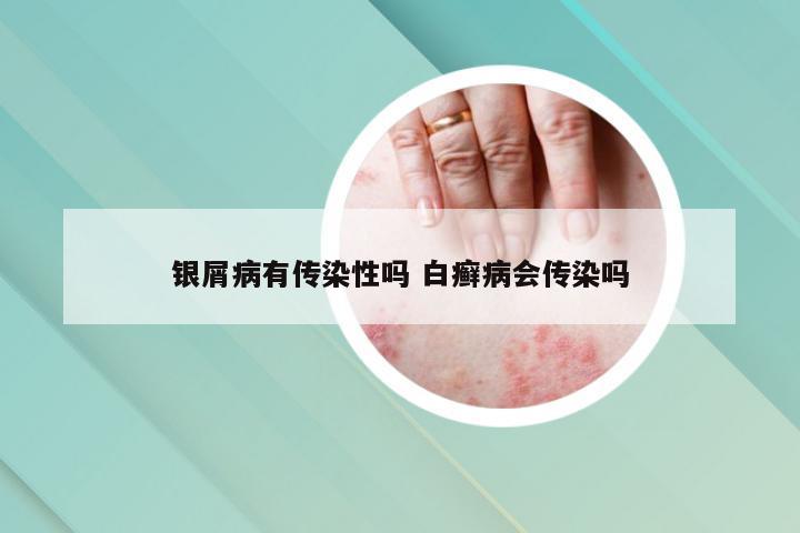 银屑病有传染性吗 白癣病会传染吗