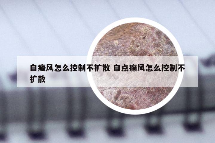 白癜风怎么控制不扩散 白点癫风怎么控制不扩散