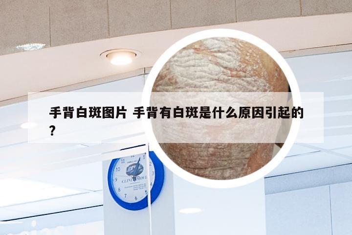 手背白斑图片 手背有白斑是什么原因引起的?
