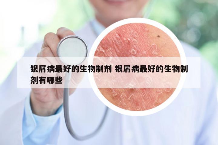 银屑病最好的生物制剂 银屑病最好的生物制剂有哪些