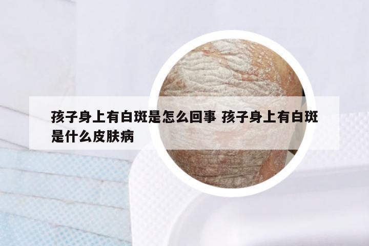 孩子身上有白斑是怎么回事 孩子身上有白斑是什么皮肤病