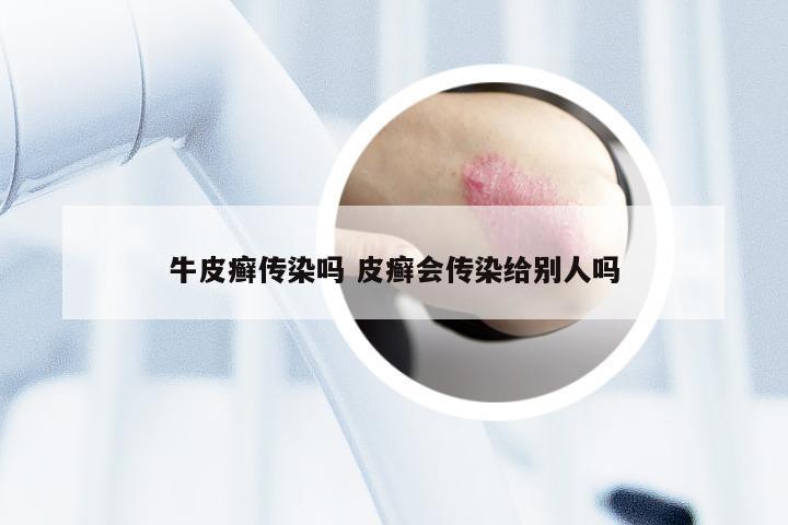 牛皮癣传染吗 皮癣会传染给别人吗
