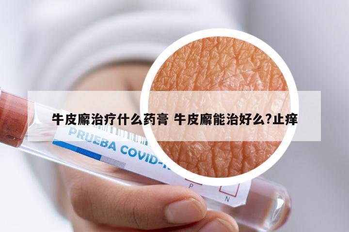 牛皮廨治疗什么药膏 牛皮廨能治好么?止痒
