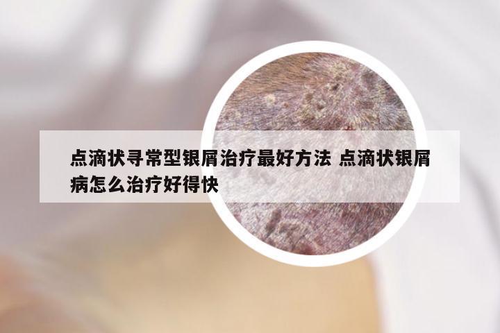 点滴状寻常型银屑治疗最好方法 点滴状银屑病怎么治疗好得快