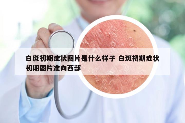 白斑初期症状图片是什么样子 白斑初期症状初期图片准向西部