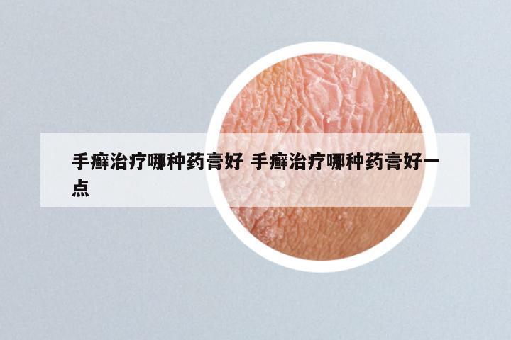 手癣治疗哪种药膏好 手癣治疗哪种药膏好一点