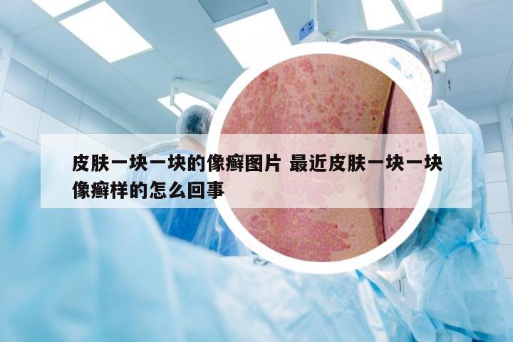 皮肤一块一块的像癣图片 最近皮肤一块一块像癣样的怎么回事