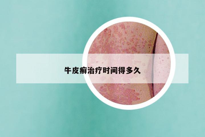 牛皮癣治疗时间得多久