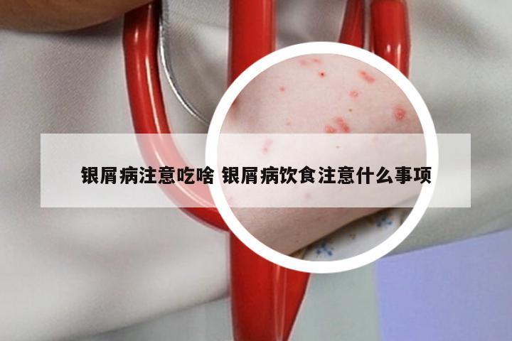 银屑病注意吃啥 银屑病饮食注意什么事项