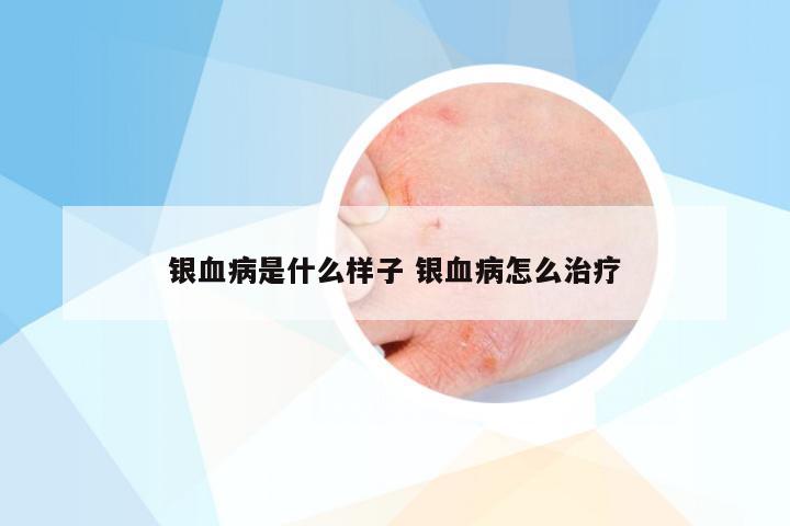 银血病是什么样子 银血病怎么治疗