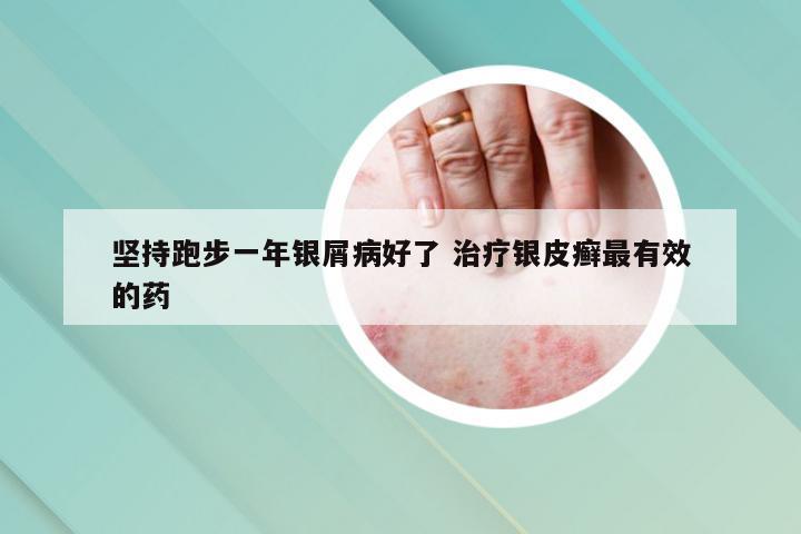 坚持跑步一年银屑病好了 治疗银皮癣最有效的药