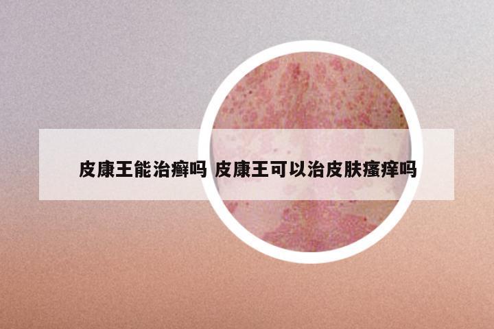 皮康王能治癣吗 皮康王可以治皮肤瘙痒吗