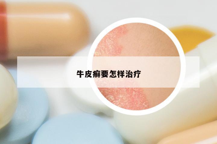 牛皮癣要怎样治疗
