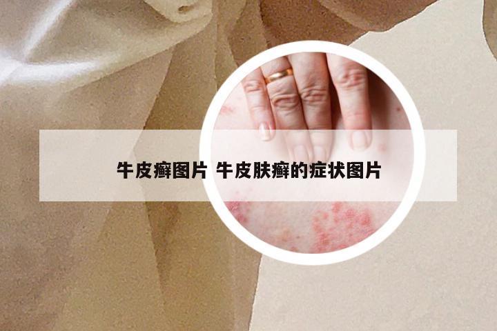 牛皮癣图片 牛皮肤癣的症状图片