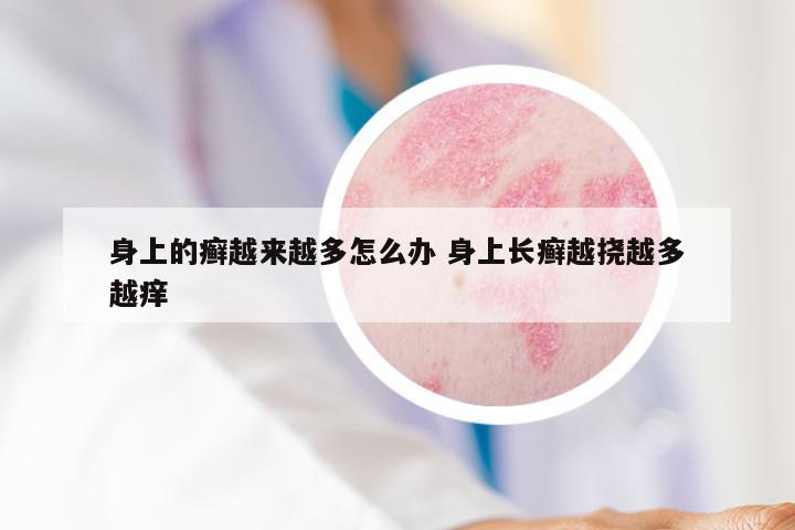 身上的癣越来越多怎么办 身上长癣越挠越多越痒