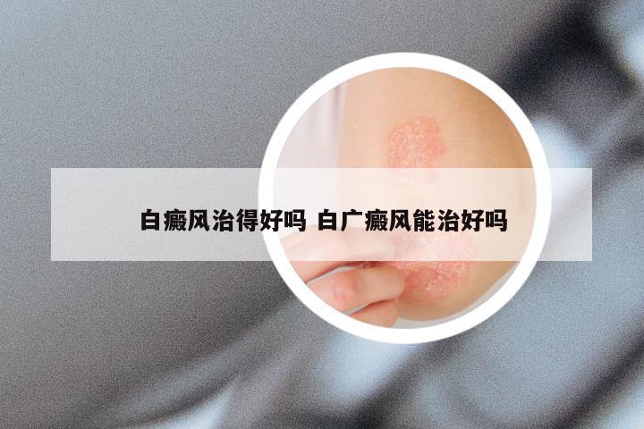 白癜风治得好吗 白广癜风能治好吗