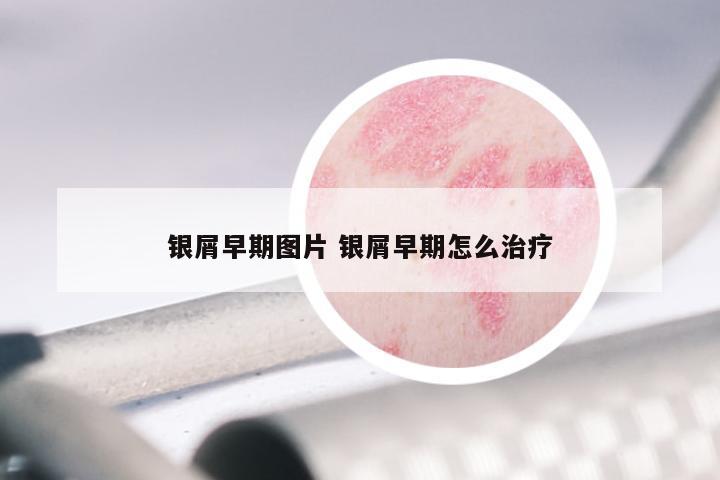 银屑早期图片 银屑早期怎么治疗