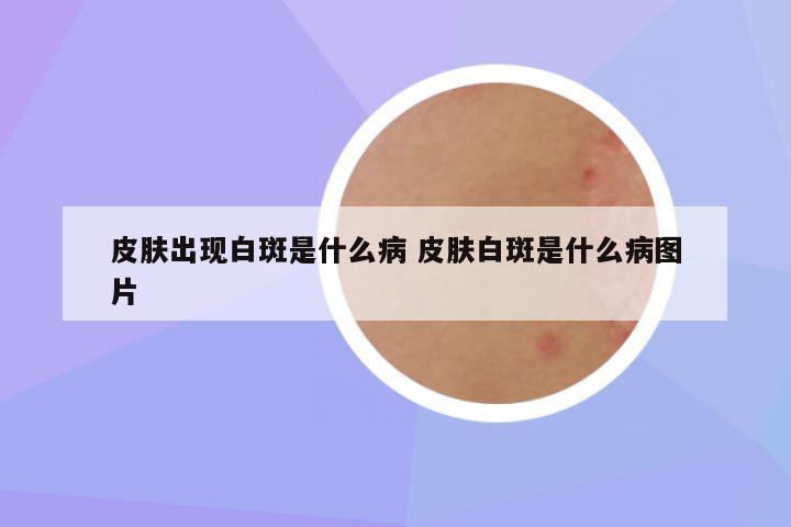 皮肤出现白斑是什么病 皮肤白斑是什么病图片