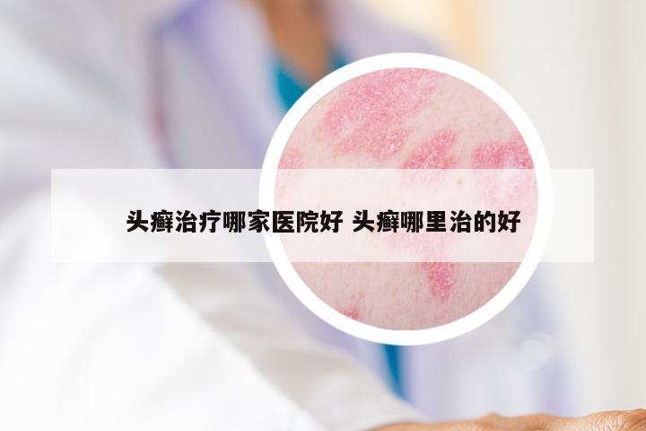头癣治疗哪家医院好 头癣哪里治的好