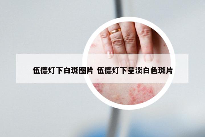 伍德灯下白斑图片 伍德灯下呈淡白色斑片