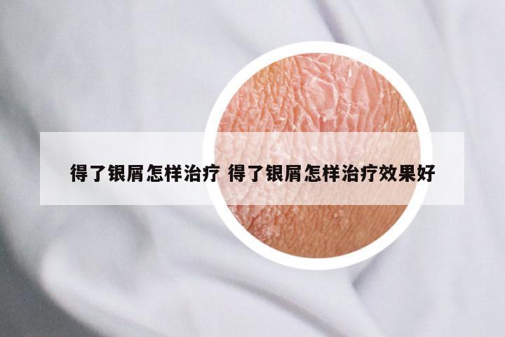 得了银屑怎样治疗 得了银屑怎样治疗效果好