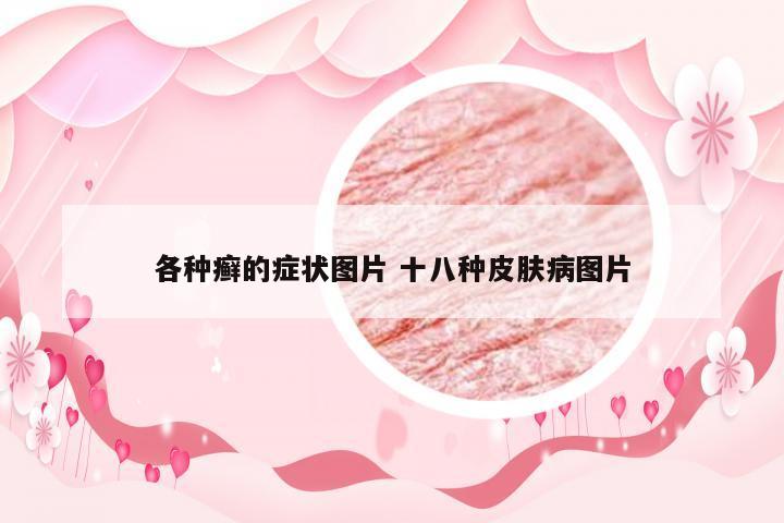各种癣的症状图片 十八种皮肤病图片