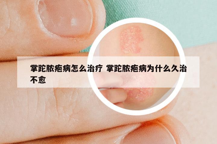 掌跎脓疱病怎么治疗 掌跎脓疱病为什么久治不愈