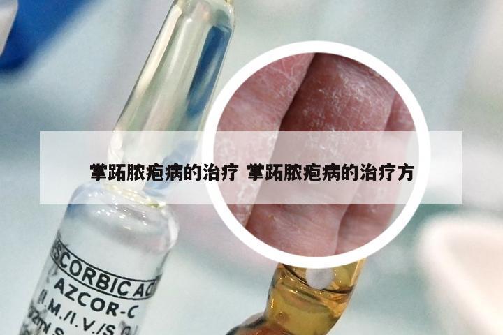 掌跖脓疱病的治疗 掌跖脓疱病的治疗方