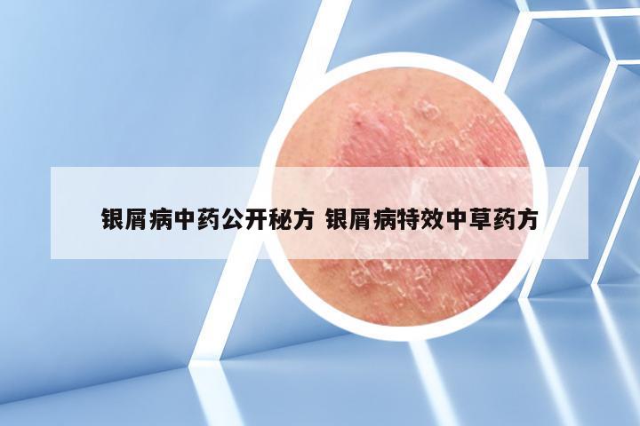 银屑病中药公开秘方 银屑病特效中草药方